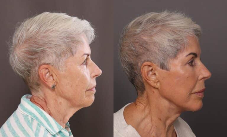 Before Image: Facelift, Blepharoplasty, Fat Grafting, Contour TRL, Botox, Dermal Fillers, and Hydrafacial - front