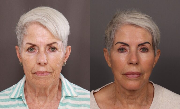 Before Image: Facelift, Blepharoplasty, Fat Grafting, Contour TRL, Botox, Dermal Fillers, and Hydrafacial - front