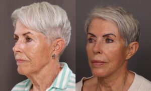After Image: Facelift, Blepharoplasty, Fat Grafting, Contour TRL, Botox, Dermal Fillers, and Hydrafacial