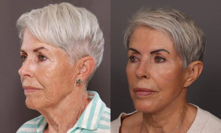 After Image: Facelift, Blepharoplasty, Fat Grafting, Contour TRL, Botox, Dermal Fillers, and Hydrafacial - front