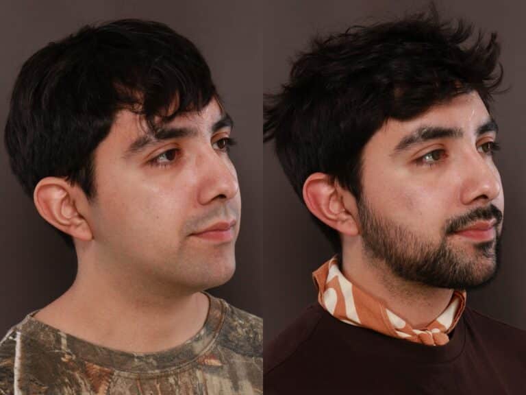 After Image: Deep Neck Contouring - front