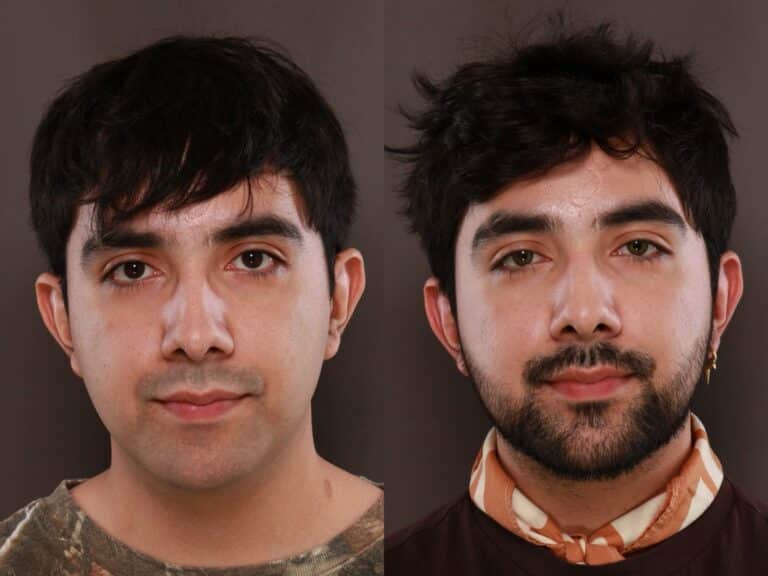 After Image: Deep Neck Contouring - 