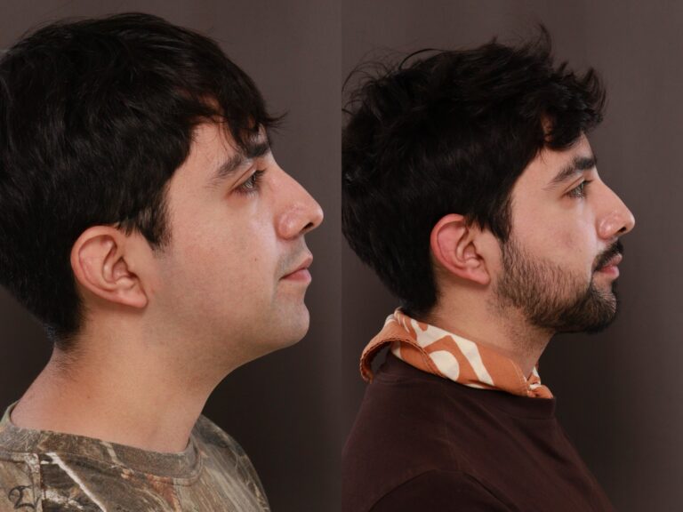 Before Image: Deep Neck Contouring - front