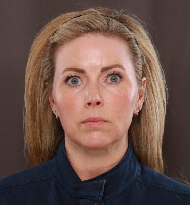 After BBL & Moxi Treatment