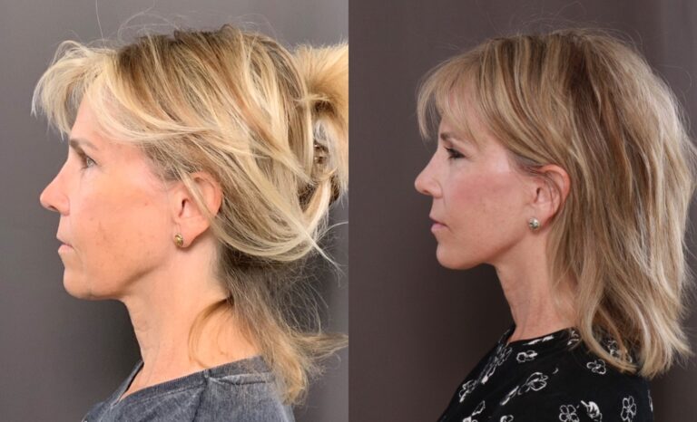 After Image: Facelift & Browlift - front