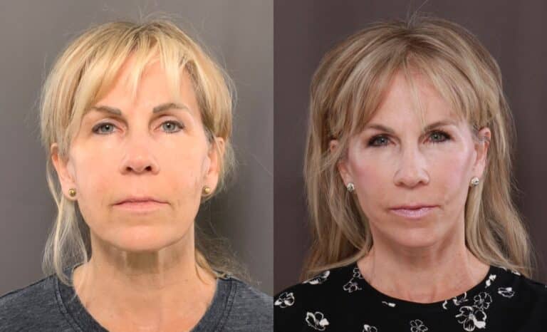 Before Image: Facelift & Browlift - front