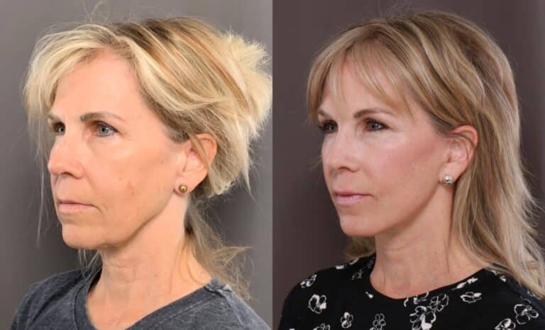 After Image: Facelift & Browlift - front