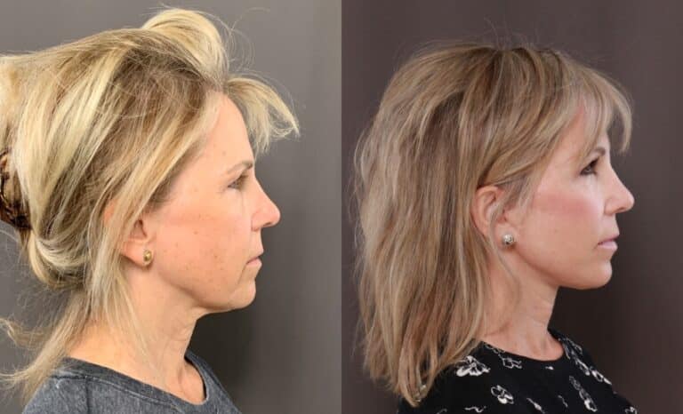 Before Image: Facelift & Browlift - front