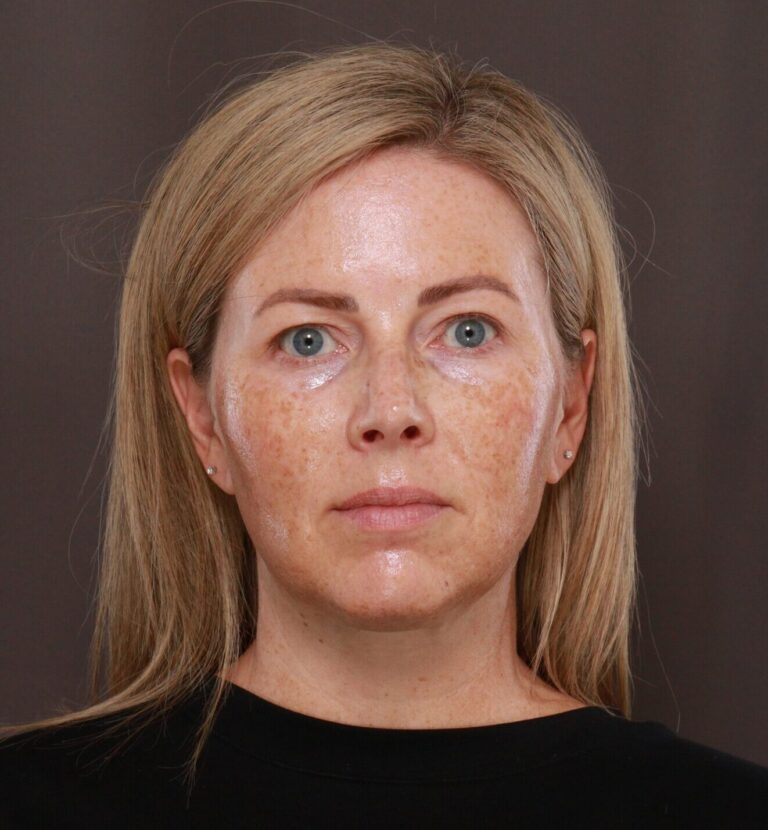 Before BBL & Moxi Treatment