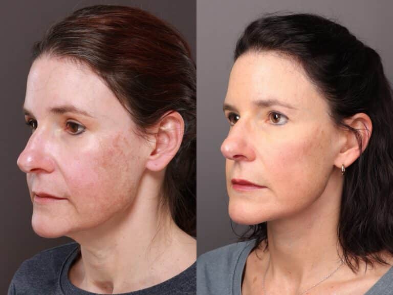 After Image: Lower Face Contouring & Upper Blepharoplasty - front