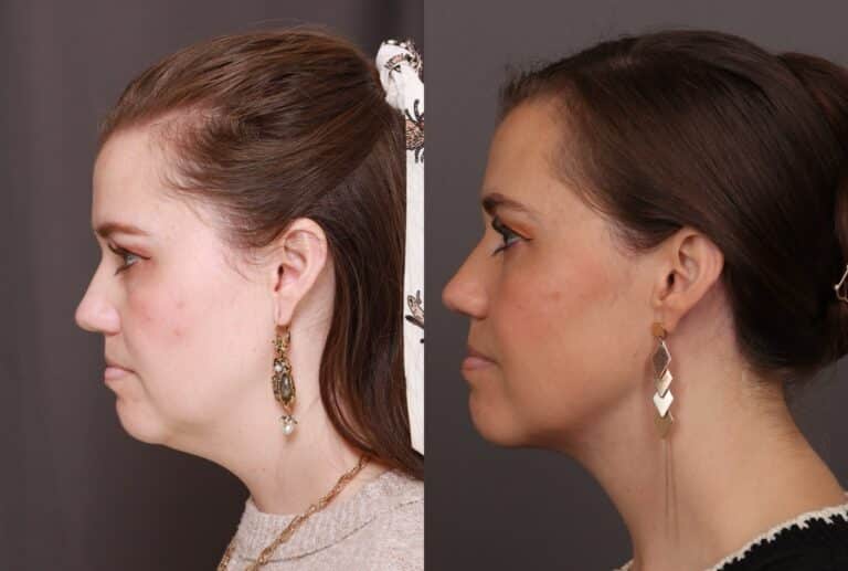 After Image: Lower Face Contouring - front