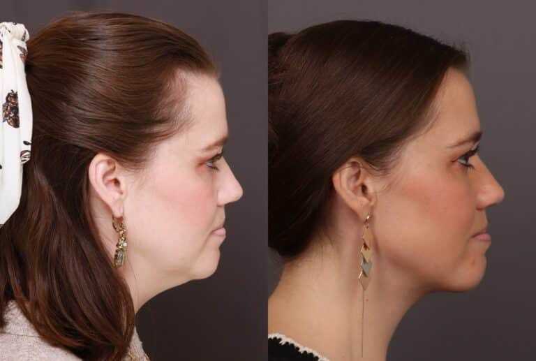 Before Image: Lower Face Contouring - front