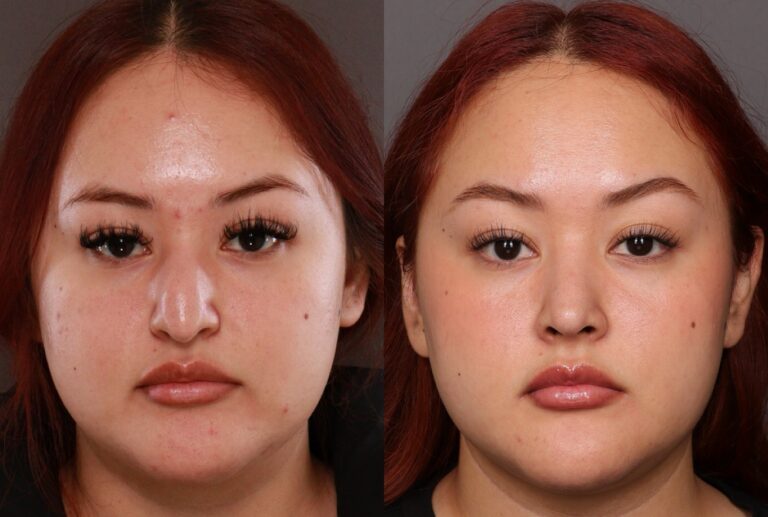 After Image: Rhinoplasty by Dr. Manning - front