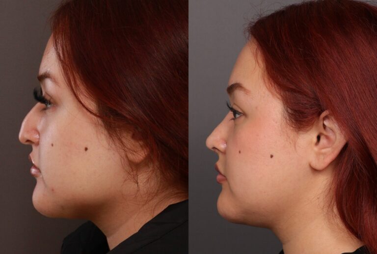 Before Image: Rhinoplasty by Dr. Manning - front