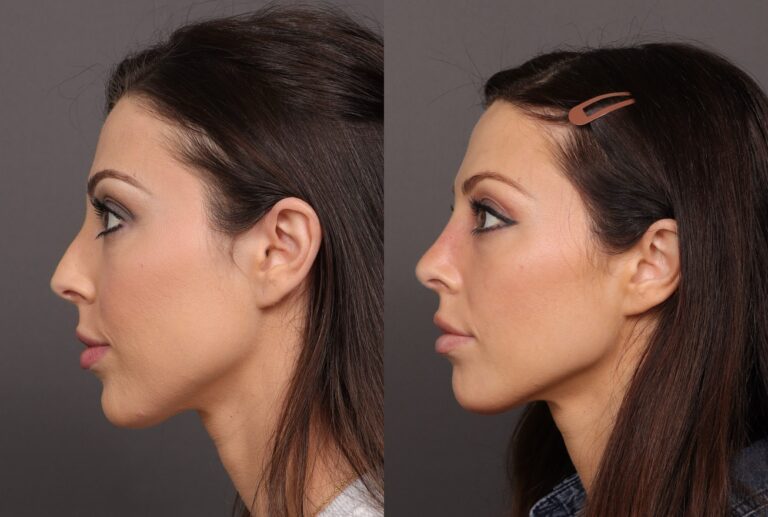 Before Image: Rhinoplasty & Chin Reduction - front