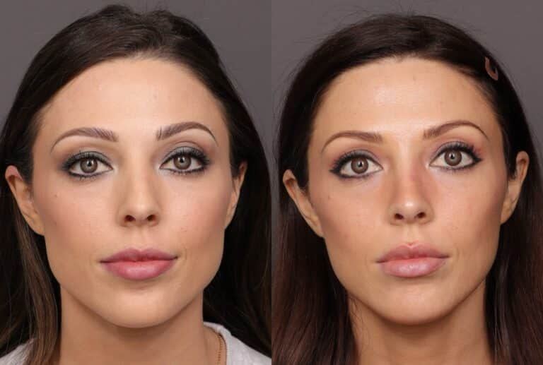 After Image: Rhinoplasty & Chin Reduction - front