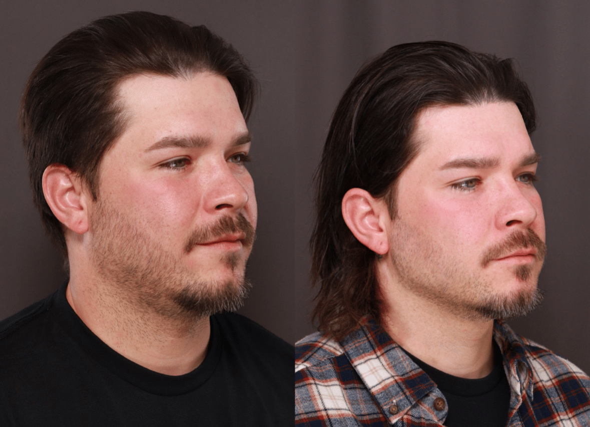 Medical Weight loss at Utah Facial Plastics