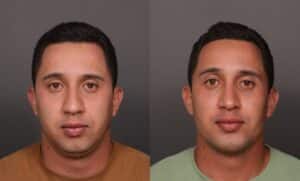 Before Image: Rhinoplasty, Chin Implant & Sub Liposuction