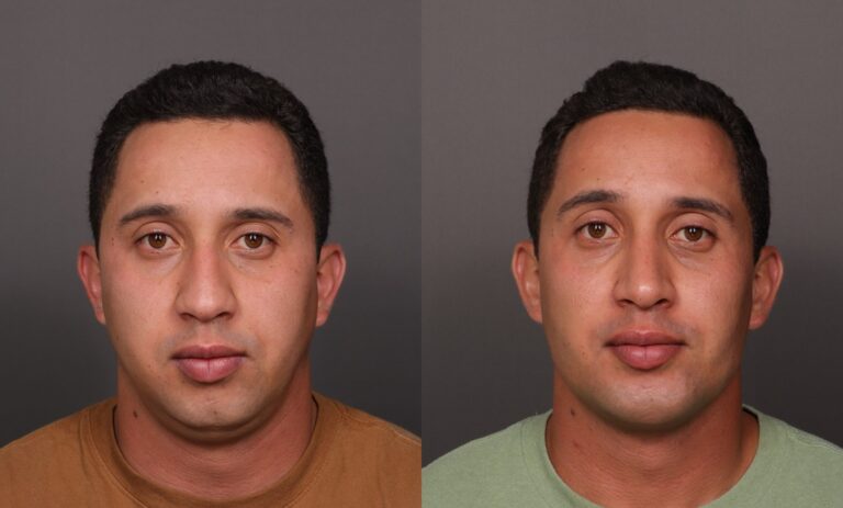 Before Image: Rhinoplasty, Chin Implant & Sub Liposuction - front