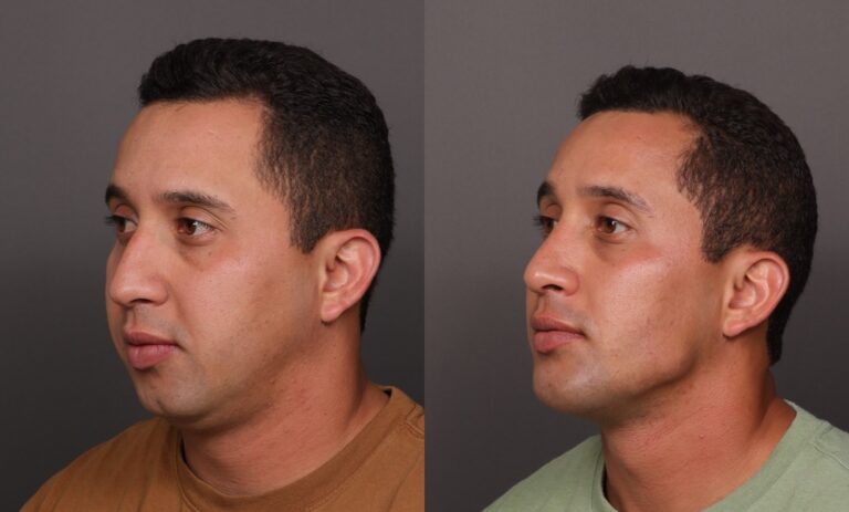 Before Image: Rhinoplasty, Chin Implant & Sub Liposuction - front