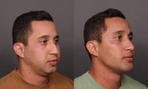 After Image: Rhinoplasty, Chin Implant & Sub Liposuction
