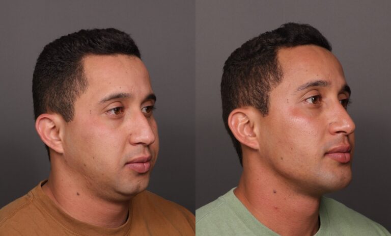 After Image: Rhinoplasty, Chin Implant & Sub Liposuction - front