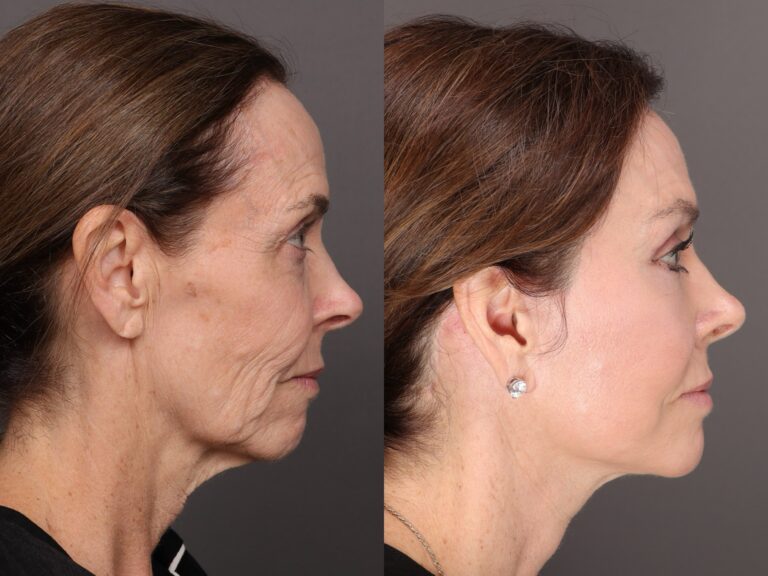 After Image: Facelift & Contour TRL - front
