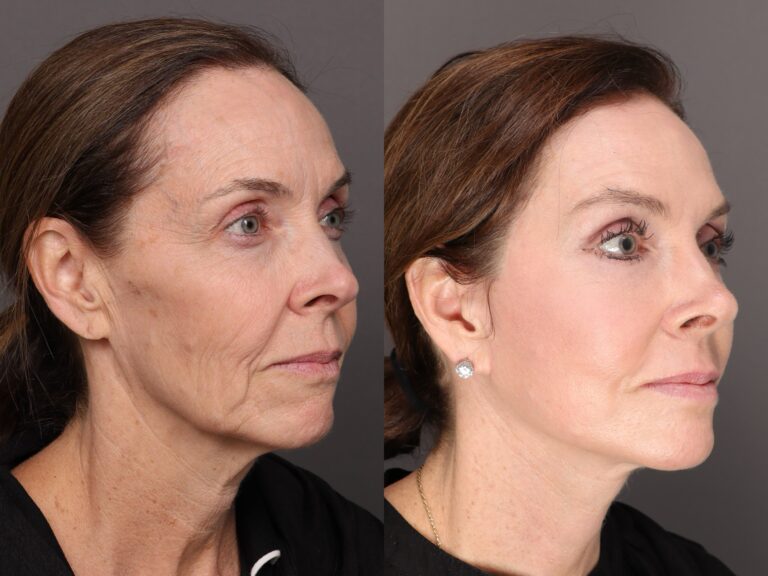 Before Image: Facelift & Contour TRL - front