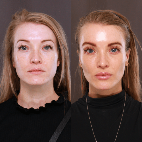 Full Face Rejuvenation