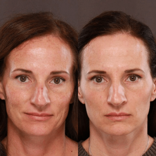 Halo Laser Treatment (2)