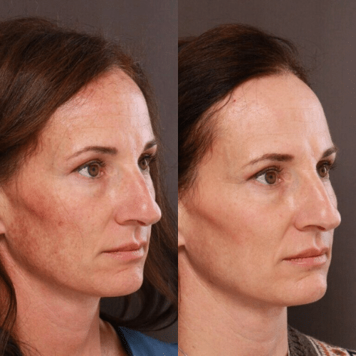 Halo Laser Treatment