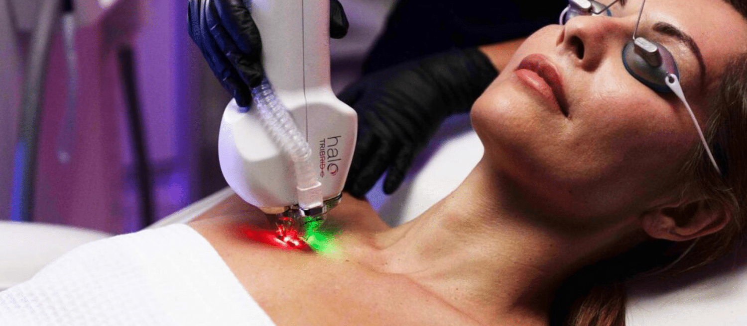 Halo Tribrid Fractional Laser