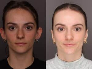 Before Image: Otoplasty