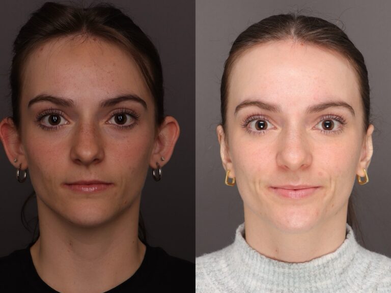 Before Image: Otoplasty - front