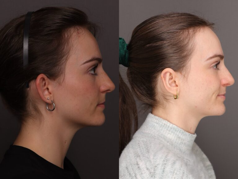 After Image: Otoplasty - 