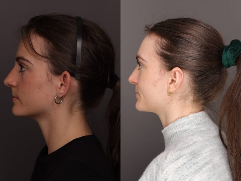 Before Image: Otoplasty - 