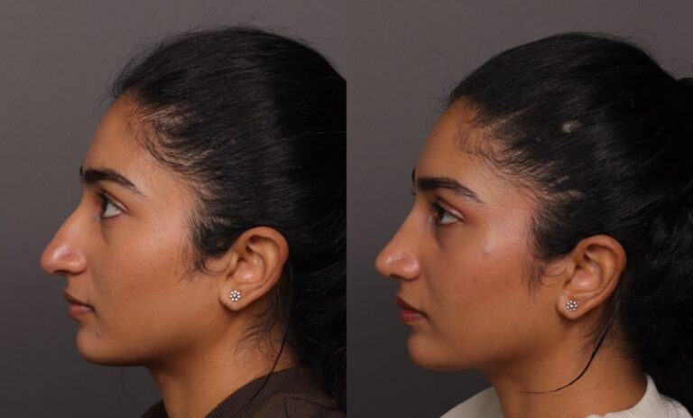 After Image: Rhinoplasty - front