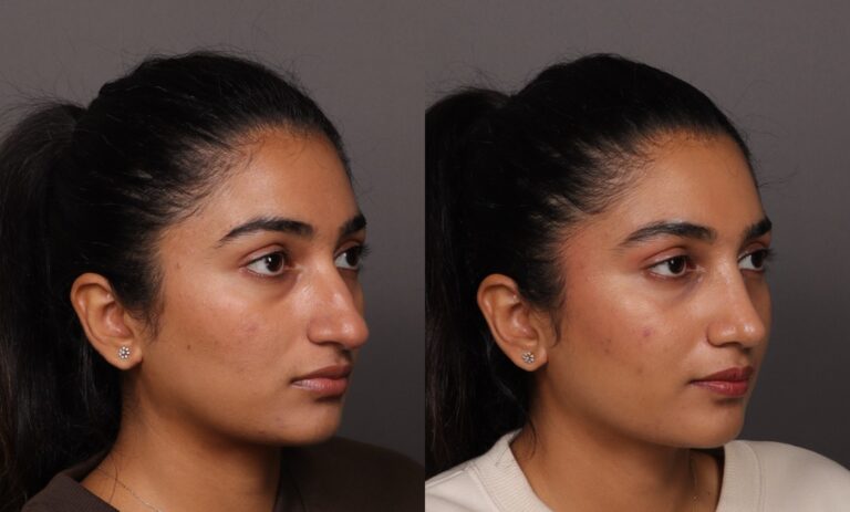 Before Image: Rhinoplasty - front
