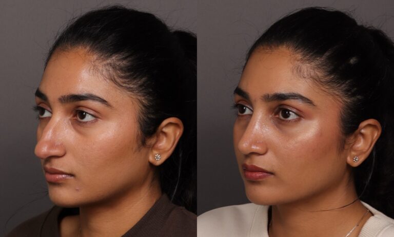 Before Image: Rhinoplasty - front