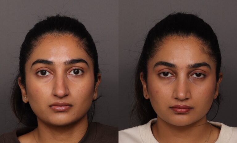 Before Image: Rhinoplasty - front
