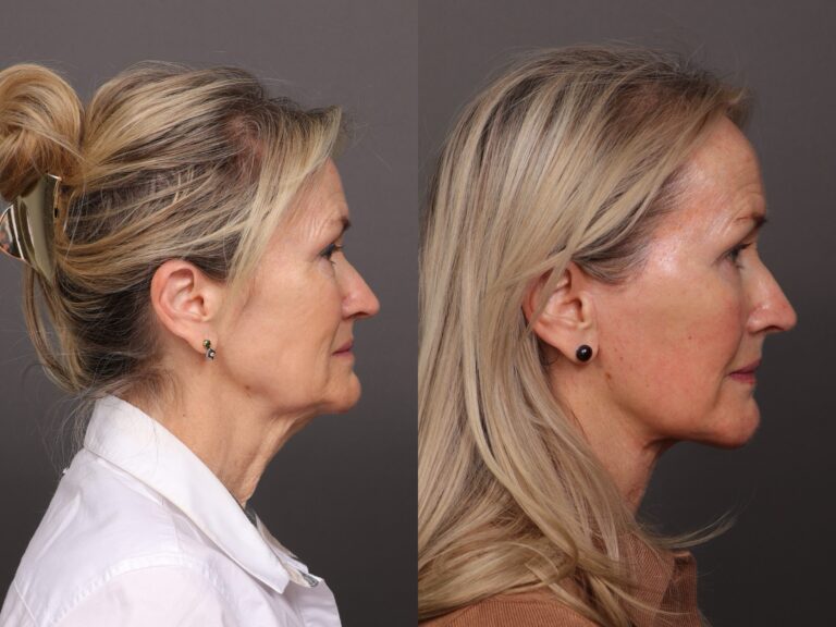 Before Image: Facelift & Botox - front