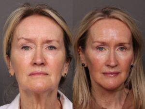 Before Image: Facelift, Botox, Hydrafacial & DiamondGlow