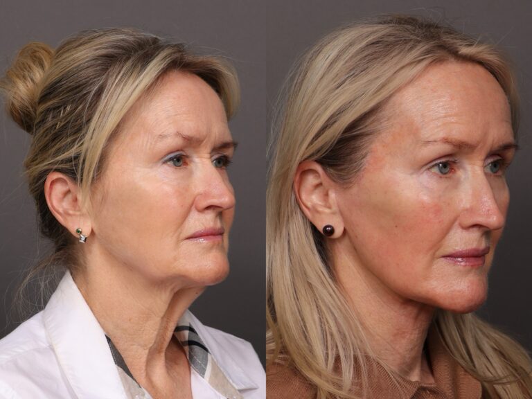 After Image: Facelift & Botox - front
