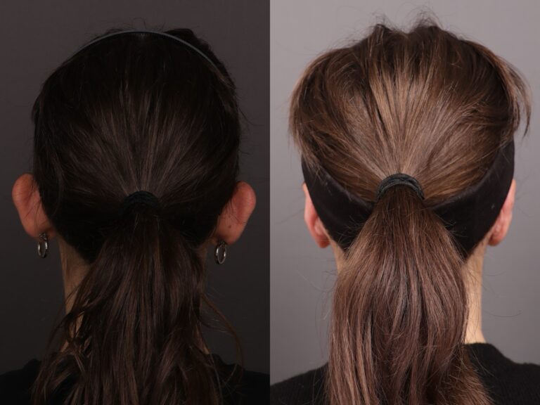 After Image: Otoplasty - front