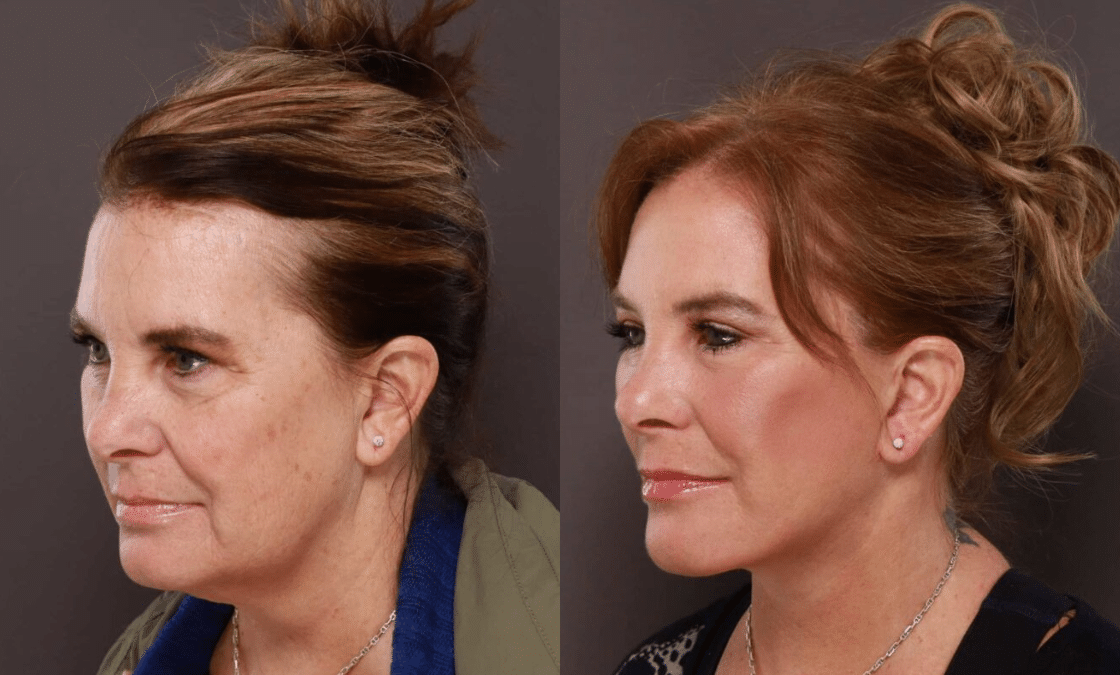 Facelift Before After 1120 x 675