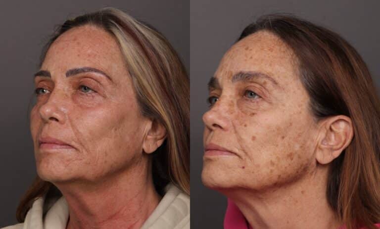 Before Image: BBL HEROic & Moxi Stacked Treatments - front