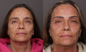 Before Image: BBL HEROic & Moxi Stacked Treatments