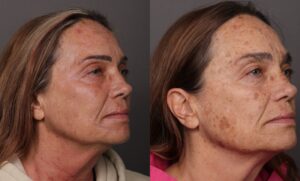 After Image: BBL HEROic & Moxi Stacked Treatments