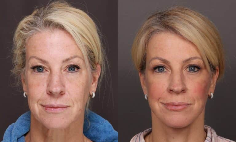 Before Image: Facelift & Upper Blepharoplasty - front
