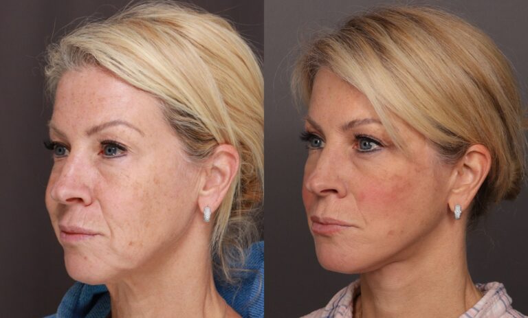 After Image: Facelift & Upper Blepharoplasty - front
